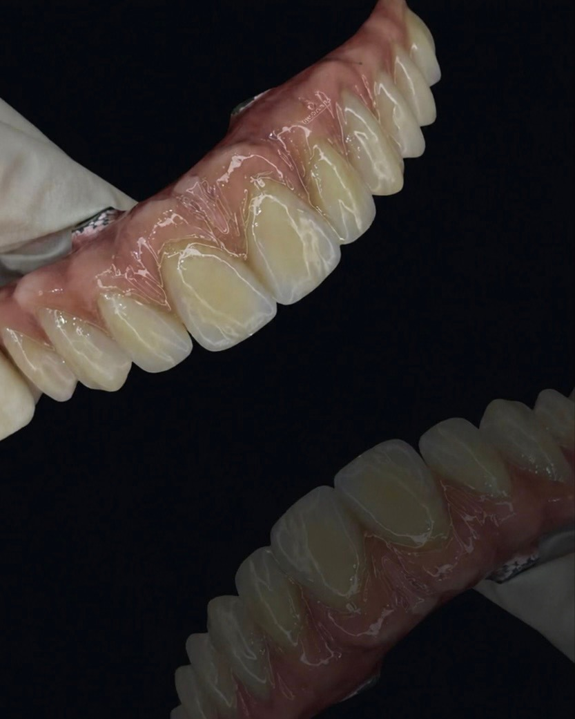 Trabalho odontológico de implante realizado pela UseOdonto