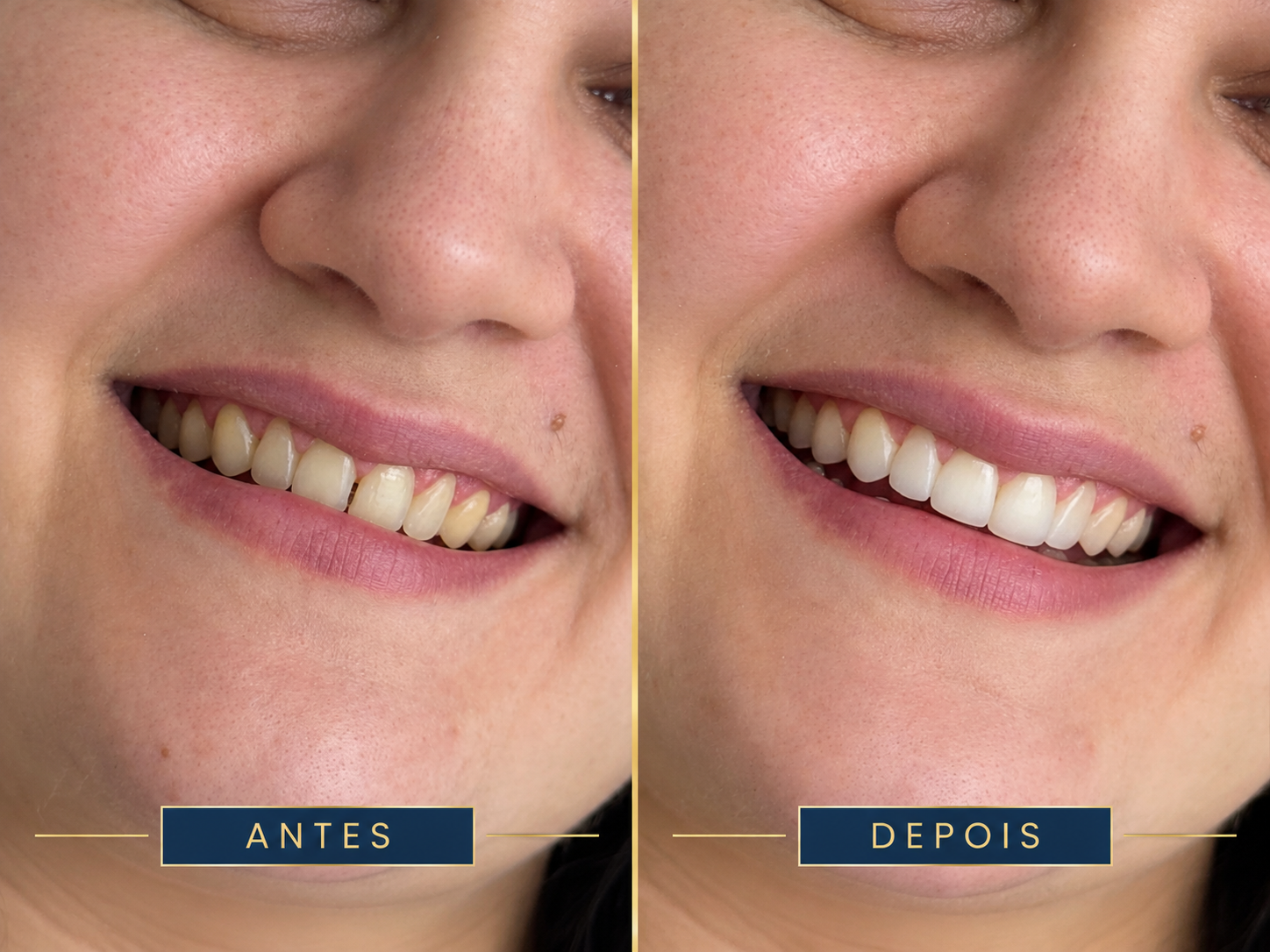Resultado de tratamento odontológico 4